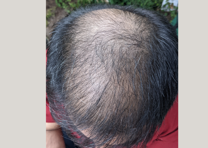 Active Scalp Renewal - Hair Serum
