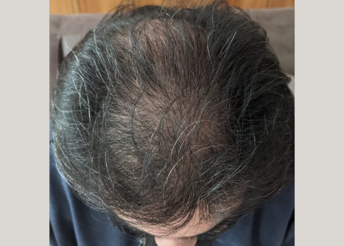Active Scalp Renewal - Hair Serum